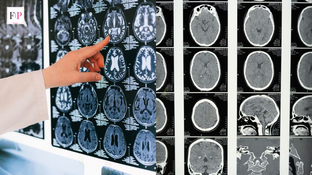Doctor examining brain MRI scans to check for brain tumour symptoms